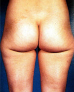 Liposuction