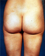 Liposuction