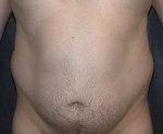 Liposuction