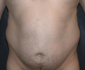 Liposuction