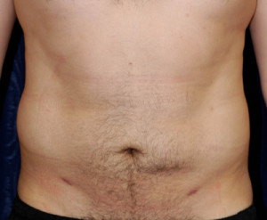 Liposuction