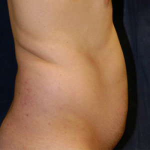 Liposuction Case 4705 Before Photo Liposuction