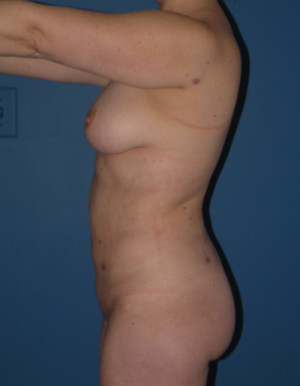 Liposuction