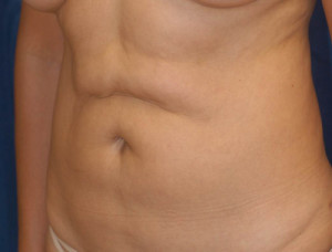 Liposuction