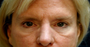 Eyelid (Blepharoplasty) Case 4447 Before Photo Eyelid (Blepharoplasty)