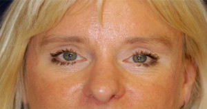 Eyelid (Blepharoplasty) Case 4447 After Photo Eyelid (Blepharoplasty)
