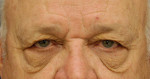 Eyelid (Blepharoplasty)