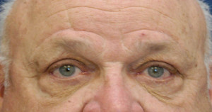 Eyelid (Blepharoplasty) Case 4451 After Photo Eyelid (Blepharoplasty)