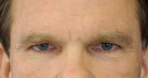 Eyelid (Blepharoplasty) Case 4455 Before Photo Eyelid (Blepharoplasty)