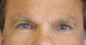 Eyelid (Blepharoplasty) Case 4455 After Photo Eyelid (Blepharoplasty)