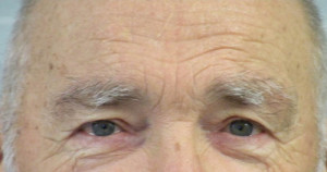 Eyelid (Blepharoplasty) Case 4459 Before Photo Eyelid (Blepharoplasty)