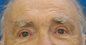 Eyelid (Blepharoplasty)