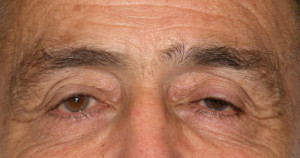 Eyelid (Blepharoplasty) Case 4463 Before Photo Eyelid (Blepharoplasty)
