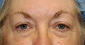 Eyelid (Blepharoplasty) Case 4471 Before Photo Eyelid (Blepharoplasty)
