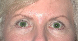 Eyelid (Blepharoplasty) Case 4475 After Photo Eyelid (Blepharoplasty)