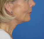 Natural Neck Lift