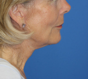 Natural Neck Lift Case 4582 After Photo Natural Neck Lift