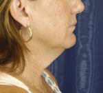 Natural Neck Lift