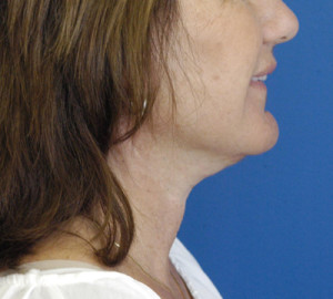 Natural Neck Lift Case 4590 After Photo Natural Neck Lift