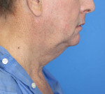 Natural Neck Lift