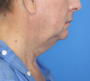 Natural Neck Lift Case 4600 Before Photo Natural Neck Lift