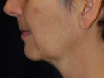 Natural Neck Lift