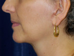 Natural Neck Lift