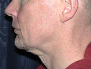 Natural Neck Lift