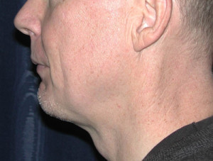 Natural Neck Lift