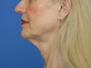 Natural Neck Lift Case 4606 Before Photo Natural Neck Lift