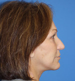 Natural Neck Lift