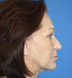 Natural Neck Lift