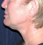 Natural Neck Lift