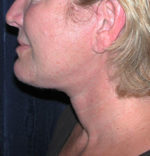 Natural Neck Lift