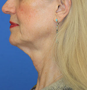 Natural Neck Lift Case 5219 Before Photo Natural Neck Lift