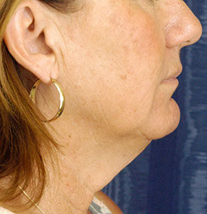 Natural Neck Lift Case 5195 Before Photo Natural Neck Lift