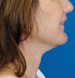 Natural Neck Lift Case 5195 After Photo Natural Neck Lift
