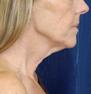 Natural Neck Lift Case 5198 Before Photo Natural Neck Lift