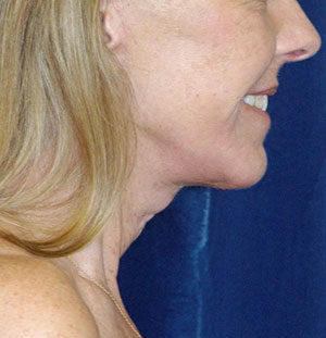 Natural Neck Lift