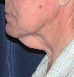 Natural Neck Lift