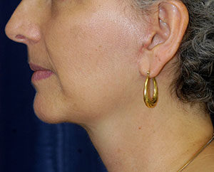 Natural Neck Lift