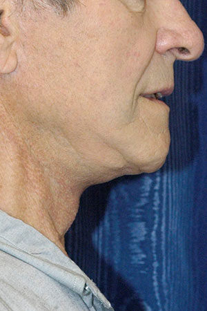 Natural Neck Lift