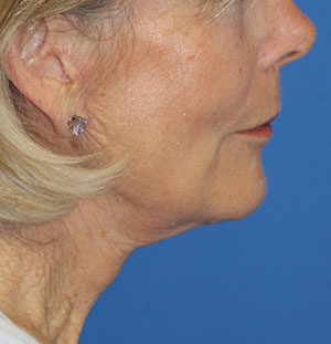 Natural Neck Lift