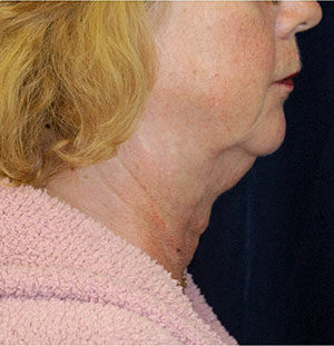 Natural Neck Lift Case 5228 Before Photo Natural Neck Lift
