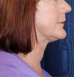 Natural Neck Lift Case 5228 After Photo Natural Neck Lift