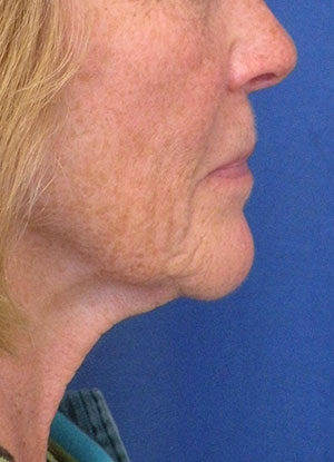 Natural Neck Lift Case 5231 Before Photo Natural Neck Lift