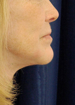 Natural Neck Lift