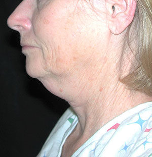 Natural Neck Lift