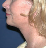 Natural Neck Lift