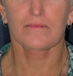Natural Neck Lift Case 5210 After Photo Natural Neck Lift